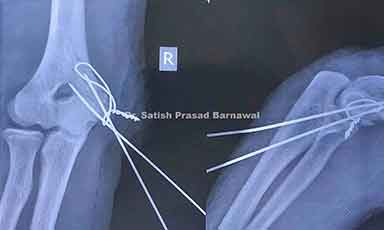 Case 3: Medial Epicondyle Humerus Fracture Treated with Tension Band Wiring