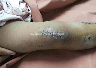 Case 3: Abscess Leg with Osteomyelitis Tibia with