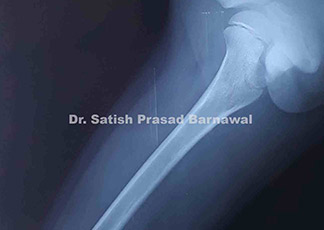 Case 4: Osteomyelitis of Proximal Femur in a Child