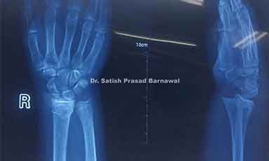 Case 4: Distal Radius Physeal Injury Treated with Pinning