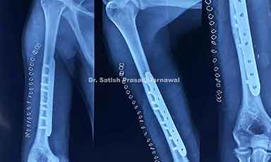 Case 5: Humerus Fracture with Surgical Site Infection with Plate and Screws Backout