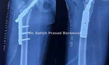 Case 5: Complex Hip Fracture Treated with Pediatric DHS