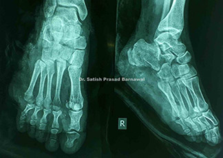 Case 4: Degloving Injury Leg and Ankle