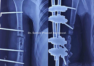 Case 5: Humerus Fracture with Implant Failure with Surgical Site Infection