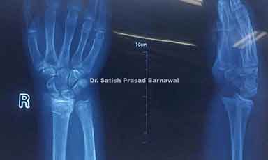 Case 6: Radius and Ulna Fracture Treated with Cast Application