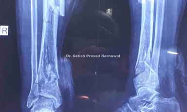 Case 6: Open Multifragmentary Middle-Distal Third Tibia Fracture Treated with External Fixator, Skin Grafting and Conservatively