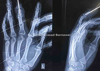 Case 6: Chronic Osteomyelitis