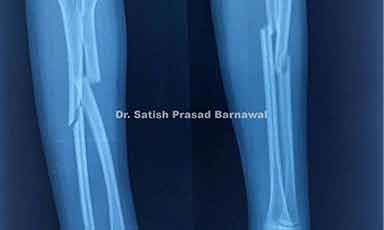 Case 7: Radius and Ulna Fracture Treated with Rush Pin Fixation
