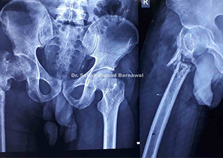Case 7: Open Subtrochanteric Femur Fracture Managed with External Fixator Application and Serial Debridement Followed by Plating and Bone Grafting