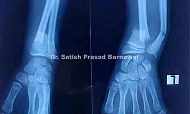 Case 8: Displaced Distal Third Radius and Ulna Fracture Treated with Cast Application