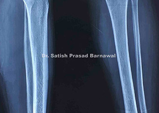 Case 8: United Left Femur Fracture with Nail in Situ with Screw Back Out with Left Thigh Compartment Syndrome with Abscess