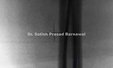 Case 1: Shaft of Femur Fracture Treated with TENS