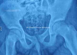 Case 5: Morel-Lavallée lesion Right Proximal Thigh