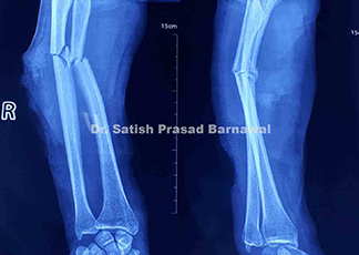 Case 6: Type 3 B Open Both bone forearm treated with serial debridement and irrigation, Rush Pin Fixation and Split Thickness Skin Graft