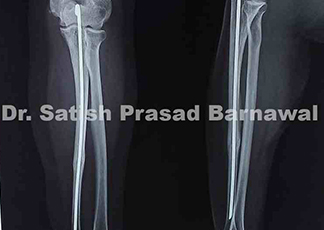 Case 7: Type 3 B Open Ulna Fracture Treated with Serial Debridement and Irrigation, Rush Pin Fixation and Split Thickness Skin Graft