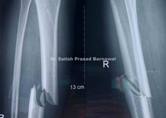 Case 10: Middle third distal third tibia fracture with medial malleolus fracture with soft tissue issue with surgical site infection with Osteomyelitis of Tibia with Discharging Sinus