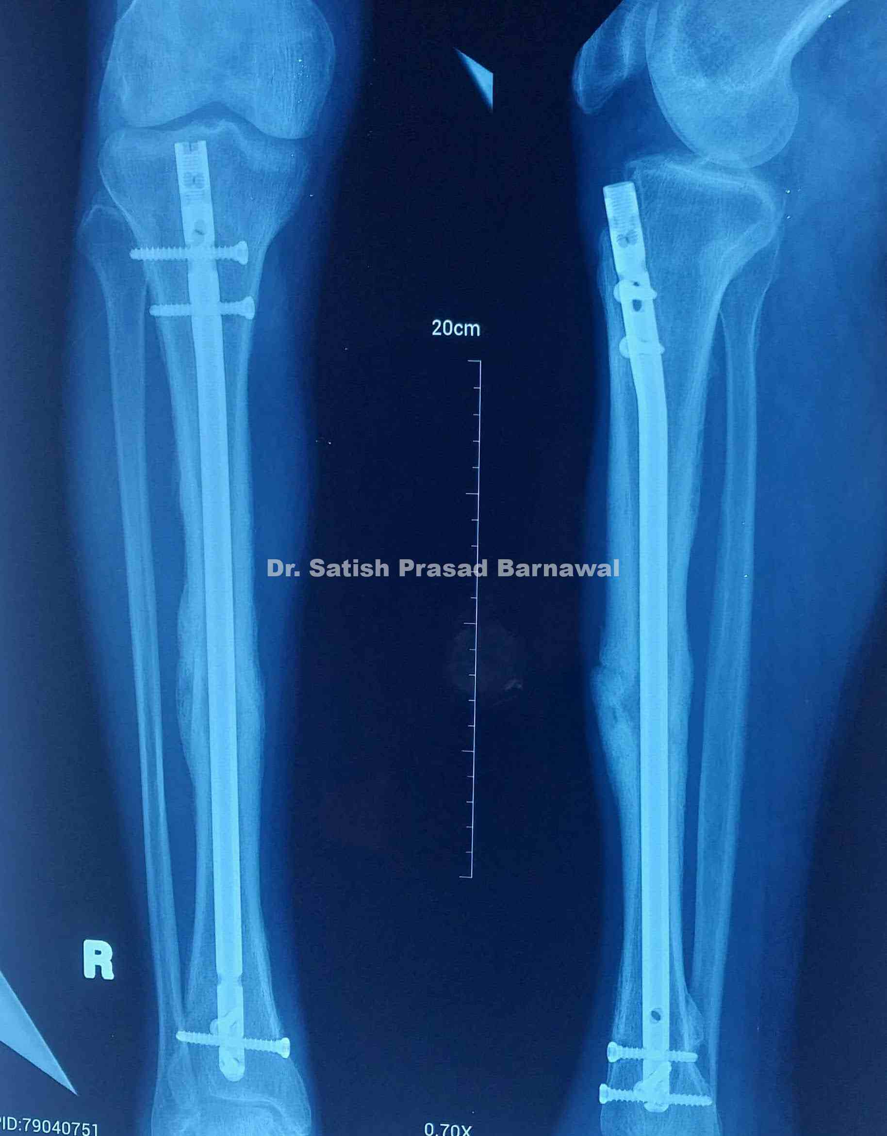 Third Tibia Case 10: Middle third distal third tibia fracture with medial malleolus ...