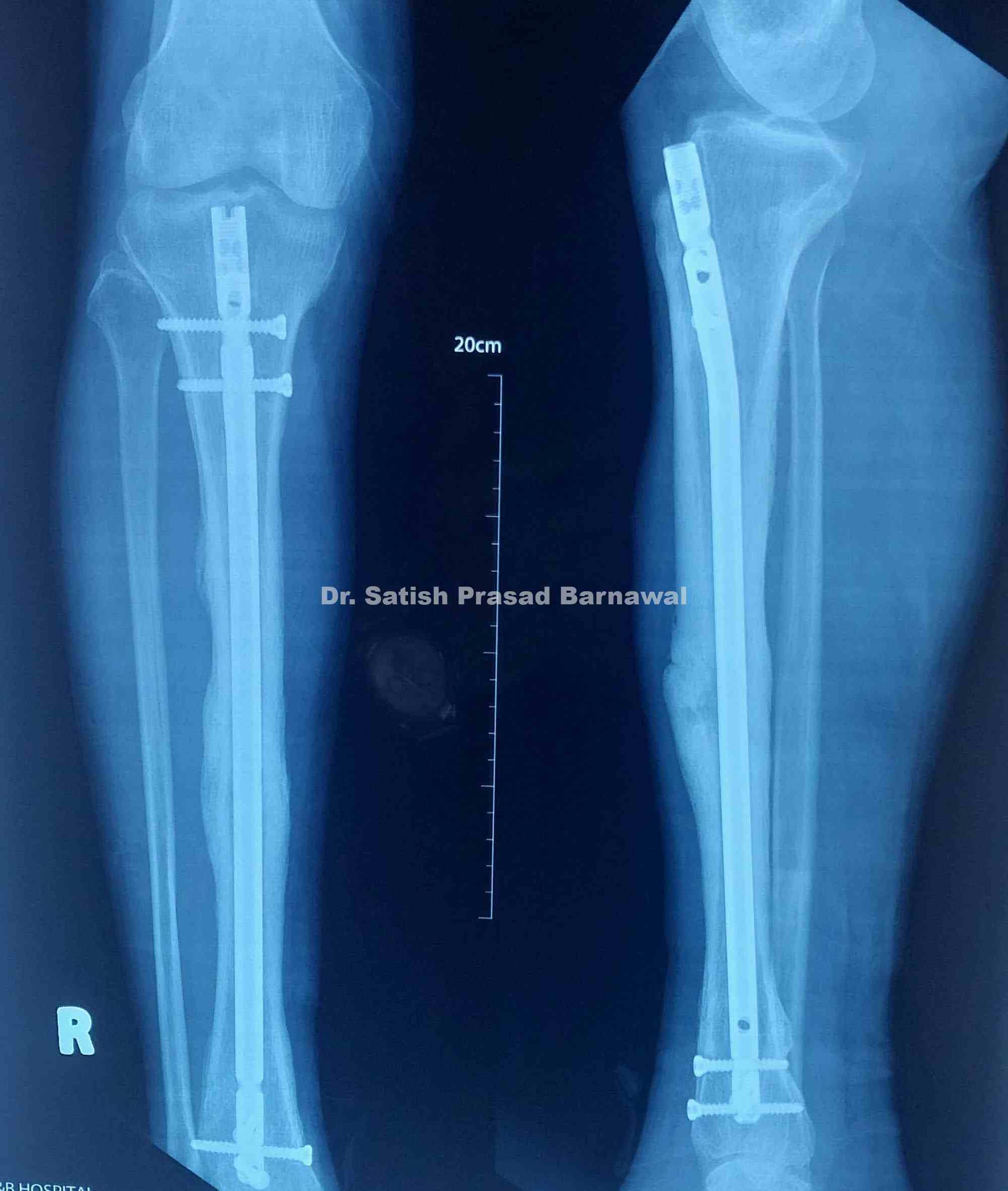 Third Tibia Case 10: Middle third distal third tibia fracture with medial malleolus ...