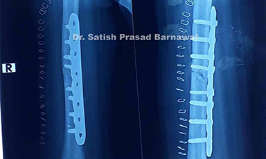 Case 1: Shaft of Humerus Fracture with Infective Non-Union with Implant Failure with Screw and Plate Backout