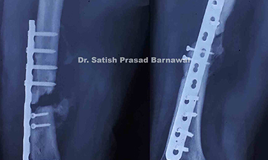 Case 2: Shaft of femur fracture with infective gap non-union successfully treated with implant removal serial reaming and intramedullary fixation and antibiotics bone cement placement