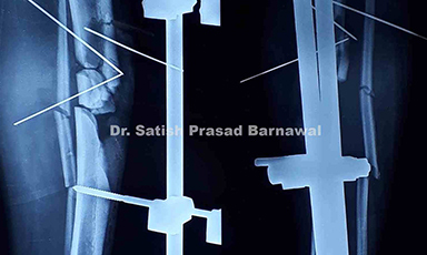 Case 3: Type 3 A open multifragmentary tibia Fracture with bone loss status post external fixator application and serial debridement treated with open reduction and internal fixation with plating and bone graft