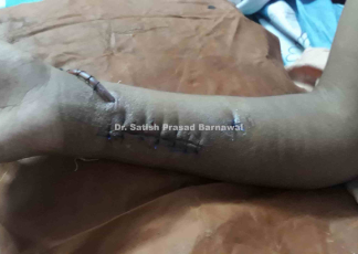 Case 9: Acute Osteomyelitis Ulna with Treated with Decompression, Drainage and Multiple Drilling