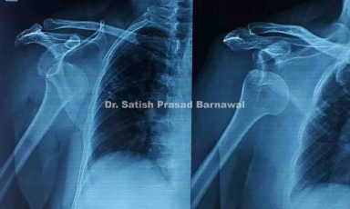 Case 8: Shoulder Dislocation Treated with Closed Reduction