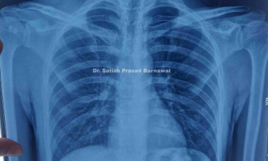 Case 9: Right Middle Third Multifragmentary Clavicle Fracture Treated without Surgery