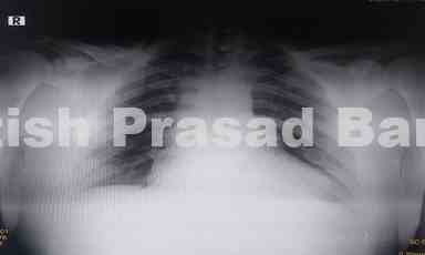 Case 10: Right Displaced Middle Third Clavicle Fracture Treated without Operation with Follow Up of 5 Years with Normal Function